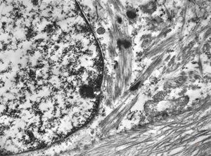 F,17y. | neck - rhabdomyosarcoma F,17y. | neck - rhabdomyosarcoma